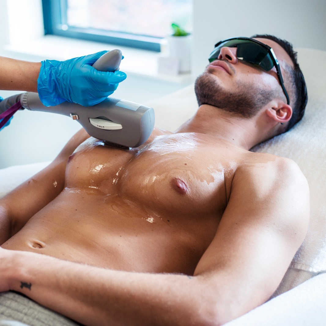 Laser ontharen mannen